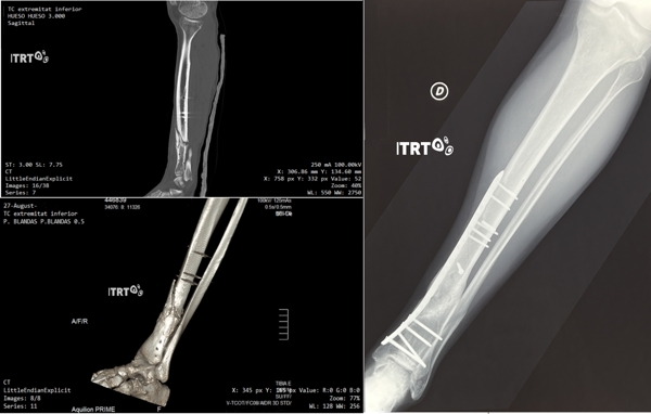 Pseudoartrosis con células madre