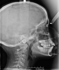 RX Telerradiografía cráneo