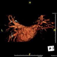 Angio-RM de Venes pulmonars