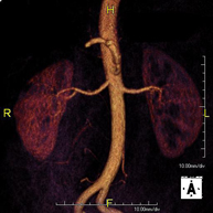Angio-RM d'Artèries renals