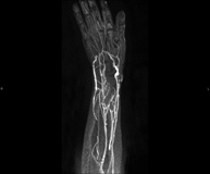 Artro-RM Lesió de parts toves