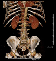 Angio-TC aorto-ilíaco