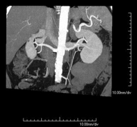 Angio-TC arterias renales_2
