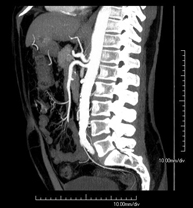 Angio-TC aorta abdominal