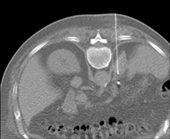 Marcaje semillas oro para radioterapia