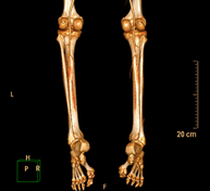 Angio-TC arterial extremidades inferiores
