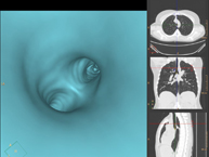 Broncoscopia virtual