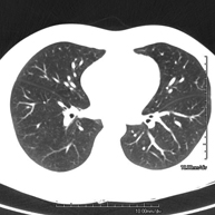 TC Tórax alta resolución