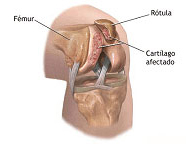 Fracturas de rótula