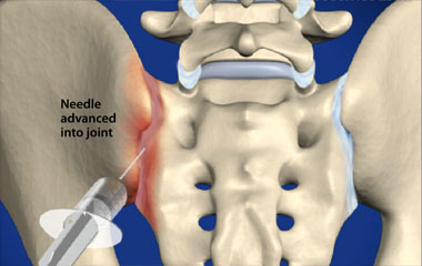Ejemplo de una infiltración intra-articular de la articulación sacroilíaca derecha