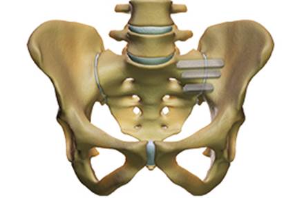 Caracterización de fusión quirúrgica percutánea de la articulación sacro-ilíaca izquierda mediante 3 implantes de titanio de perfil triangular.
