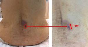Imágenes postoperatorias de la herida de 1 cm de longitud (flecha roja)