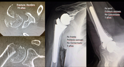 Dr-Hachem-protesis-reversa-hombro-foto-caso