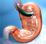 La Vía Oral para la Reducción de Estómago obtiene Excelentes Resultados para los Pacientes