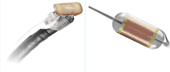 técnica diagnóstico esófago barrett