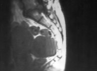 Mioma uterino (resonancia nuclear magnética)