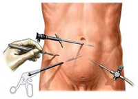 Intervención por laparoscopia