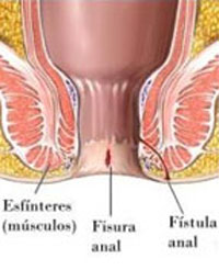Fisura anal