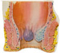 Hemorroides1