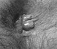 Hemorroides2
