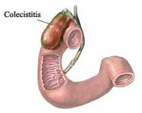 Colecistitis