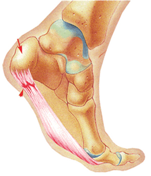 Fascitis plantar