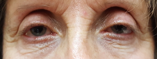 ptosis palpebral