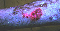 Fluorescencia rojo coral en el carcinoma superficial