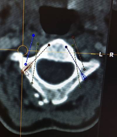 Atlantoaxial Instability Treatment