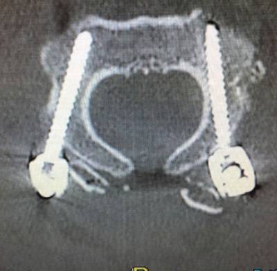 Atlantoaxial Instability Treatment 2