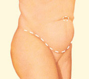 Incisión-abdominoplastia