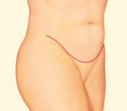 Resultado-abdominoplastia