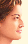 Rinoplastia antes