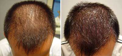 Alopecia-1