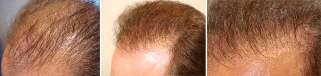 Alopecia-2