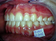 Fin del tratamiento, perfil izquierdo (izquierda) y fin del tratamiento de frente (derecha)