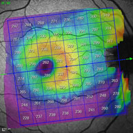 Glaucoma de ángulo cerrado