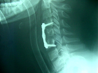 Tras la operación, alineación de las vértebras con una fijación de titanio