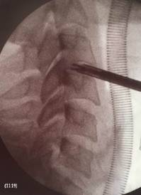 Imagen intraoperativa fluoroscópica en perfil de la columna cervical. Obsérvese la pinza endoscópica realizando una descompresión del disco intervertebral.