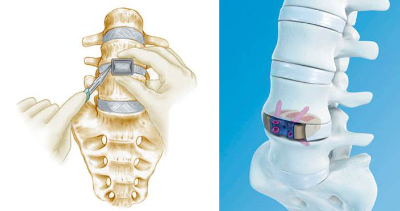 Esquema (imagen izquierda) del abordaje anterior a un disco intervertebral y de una caja intersomática de grandes dimensiones colocada en el disco interveterbal por via anterior (imagen derecha).