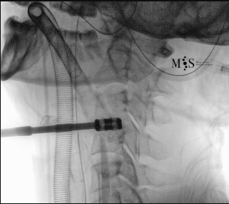 cirugía de fusión cervical endoscópica