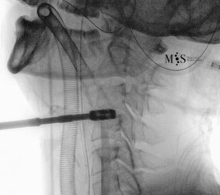 cirugía de fusión cervical endoscópica