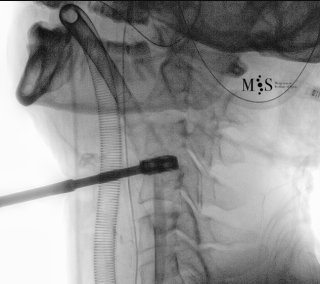 cirugía de fusión cervical endoscópica