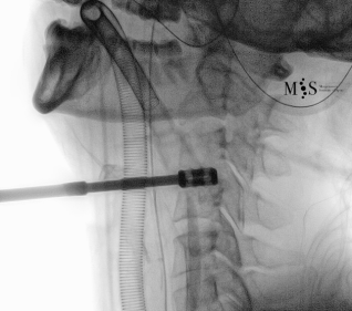 cirugía de fusión cervical endoscópica