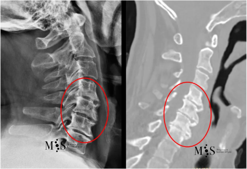 fusion endoscopica