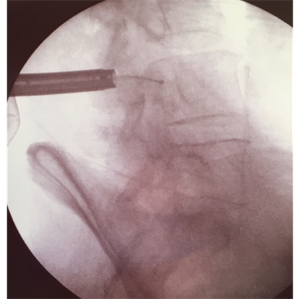 Rx intra-operatoria mostrando la cánula endoscópica (izquierda) de la que sobresale el electrodo de radiofrecuencia (con una bolita en su extremo) cruzando el canal medular.