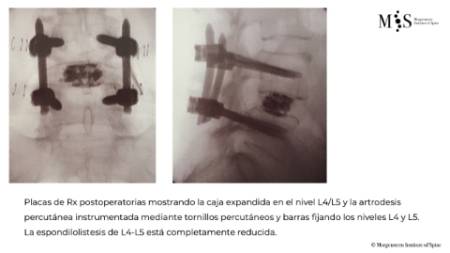 fusión endoscópica 2