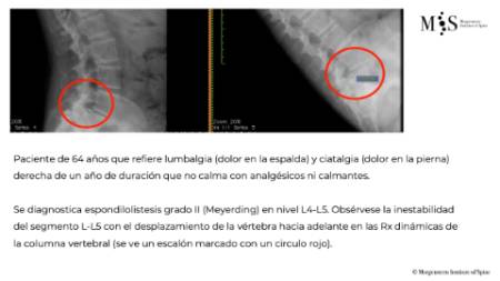 fusion endoscópica-update