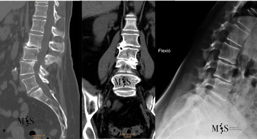 paciente con una escoliosis degenerativa lumbar