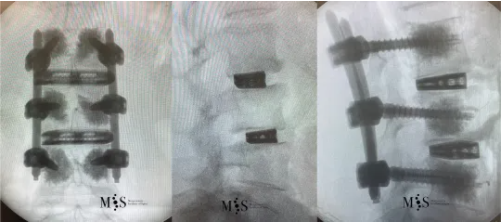 corrección post-operatoria mediante fusión oblicua-lateral (OLIF)